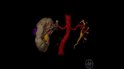 Лечение опухоли почки лапораскопически